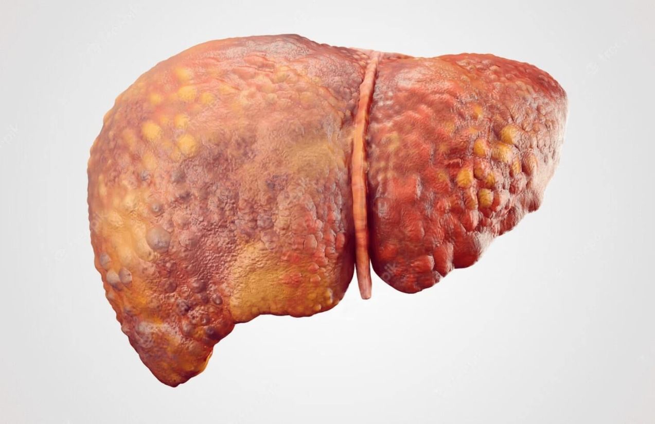 How many spoonfuls of sugar per day can You consume without risking fatty liver? How many spoonfuls of sugar per day can You consume without risking fatty liver?