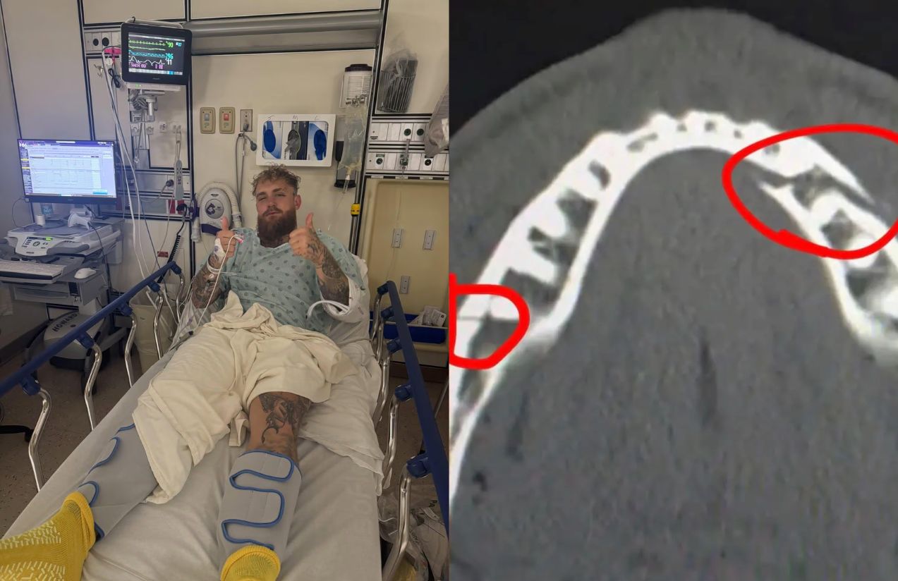 Jake Paul suffers a double jaw fracture against Anthony Joshua