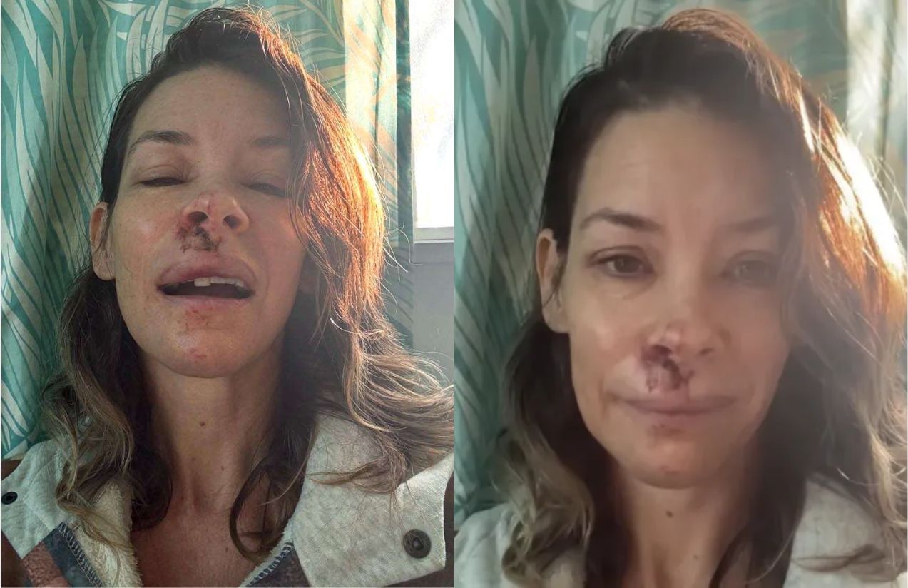 Evangeline Lilly reveals she suffers brain damage after serious accident in Hawaii