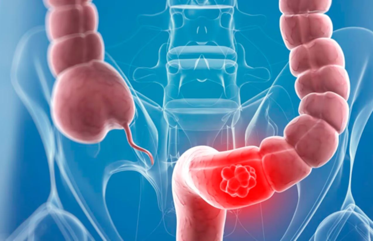 Scientists in the United States discover a key clue that could revolutionize early colon cancer diagnosis