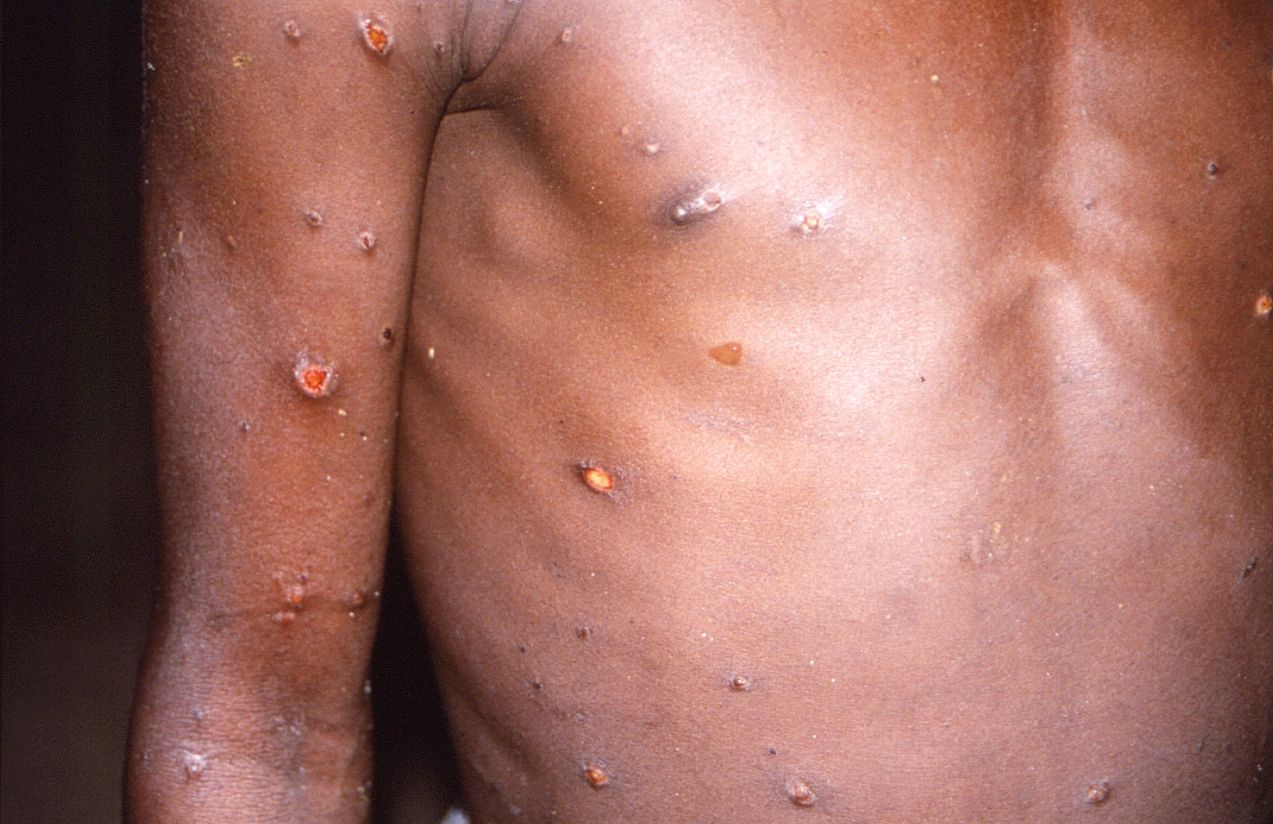 New York confirms the first case of clade I mpox in the United States