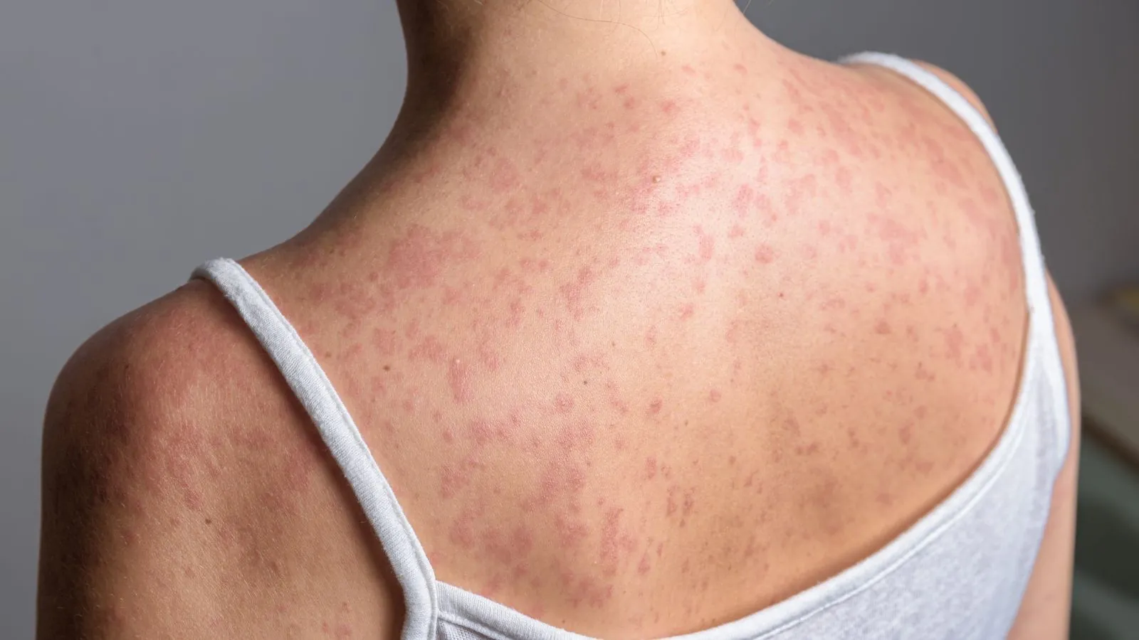 Pennsylvania measles outbreak claims third life as cases continue to rise Pennsylvania measles outbreak claims third life as cases continue to rise