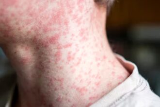 Pennsylvania measles outbreak claims third life as cases continue to rise The neck of a person covered in red bumps or a rash