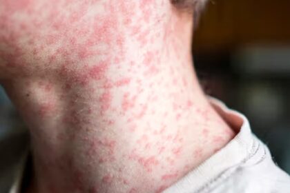 The neck of a person covered in red bumps or a rash