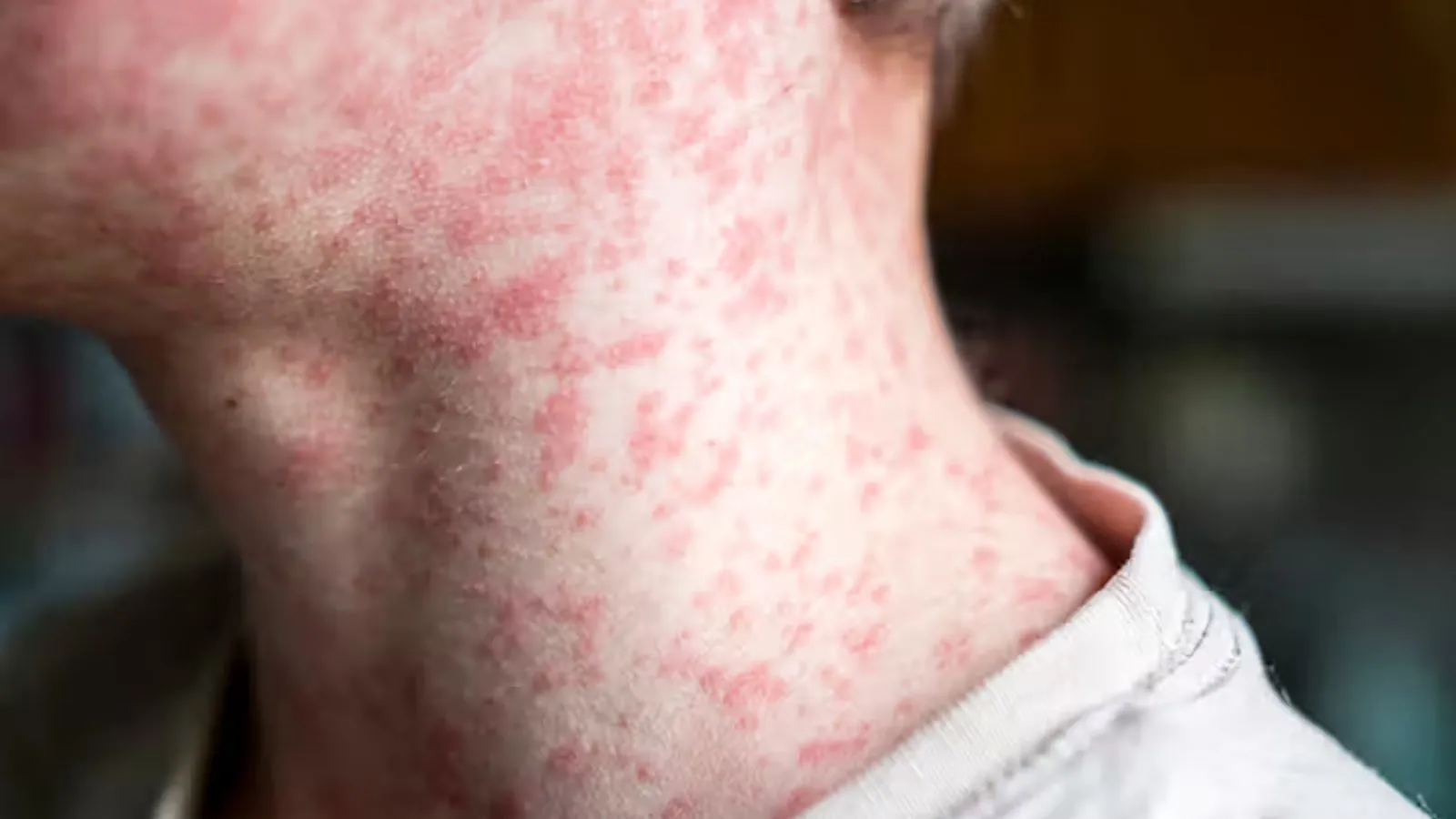 Pennsylvania measles outbreak claims third life as cases continue to rise The neck of a person covered in red bumps or a rash